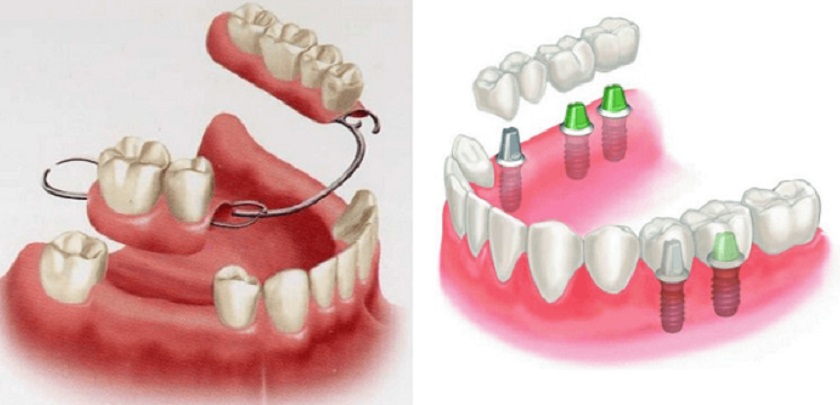 Mất răng nên lựa chọn hàm tháo lắp hay trồng răng Implant?