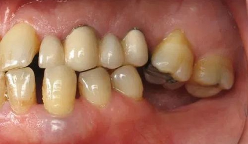 Tiêu xương do mất răng số 6