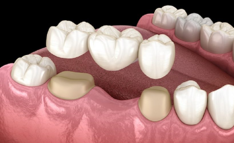 Cầu răng sứ phục hình răng số 6