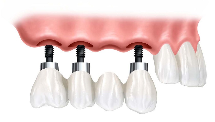 Phục hình cầu răng trên trụ Implant