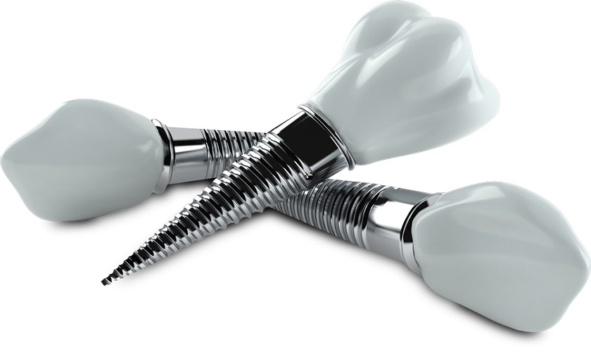 Răng Implant làm từ chất liệu gì? Đặc tính ra sao?