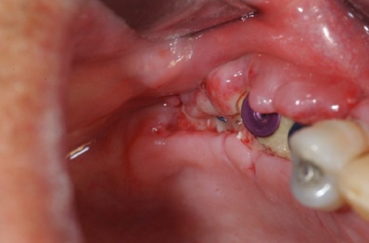 Nướu sưng đỏ là dấu hiệu nhiễm trùng quanh trụ Implant