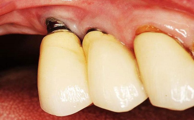 Biến chứng đào thải Implant