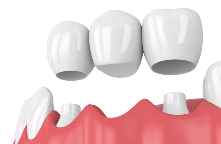 Phục hình bằng cầu răng sứ
