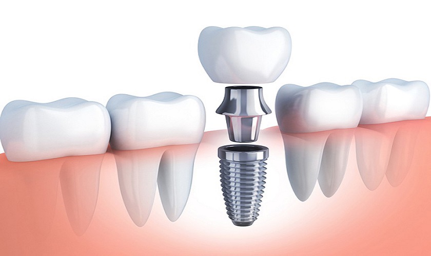 Phục hình răng bằng Implant