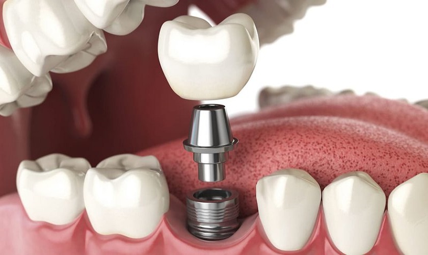 Thời gian tái khám sau cấy ghép Implant