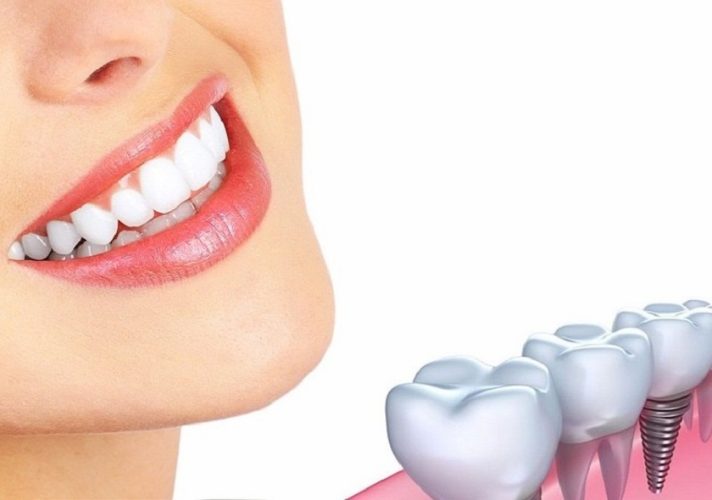 Một số vấn đề cần chú ý khi tái khám sau cấy ghép Implant