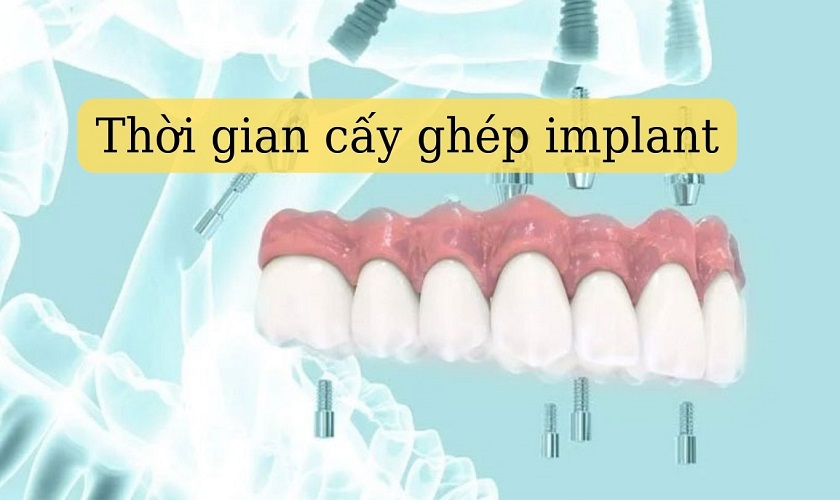Thời gian cấy ghép răng Implant