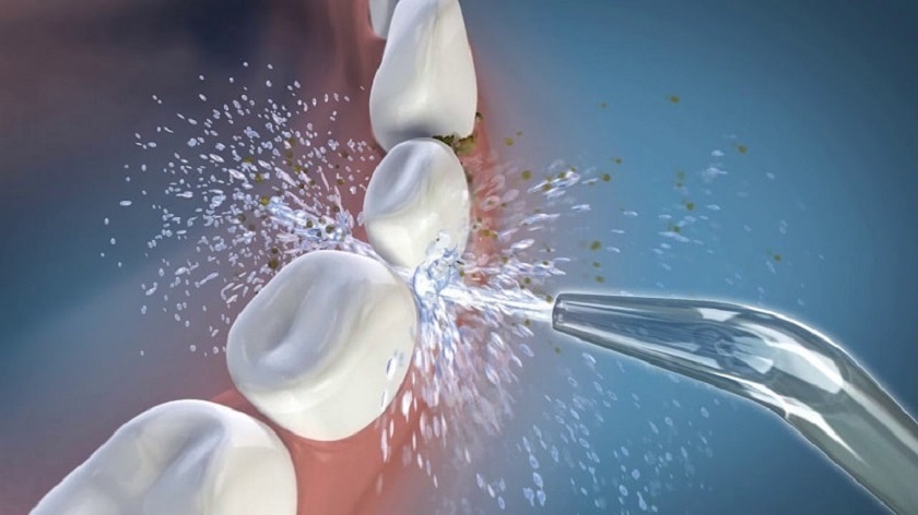 Sử dụng tăm nước để tăng cường hiệu quả làm sạch kẽ răng