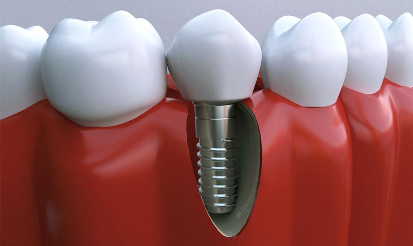 Trồng răng bằng cấy ghép implant và những ưu điểm nổi bật