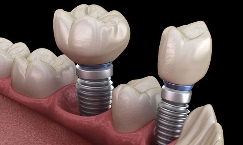 Trồng răng bằng cấy ghép Implant