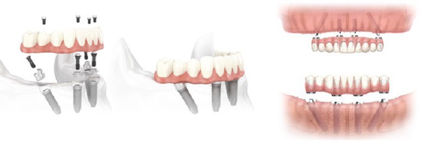 Kỹ thuật trồng răng toàn hàm Implant All on 4