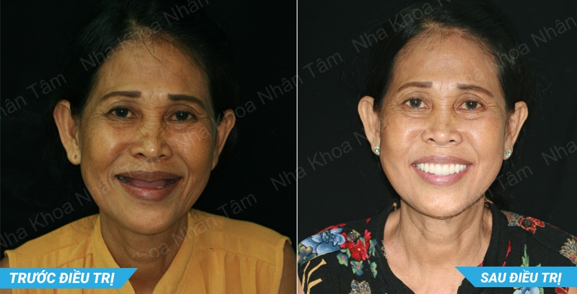 Trồng răng Implant toàn hàm All on 4 đem lại nhiều lợi ích to lớn cho khách hàng
