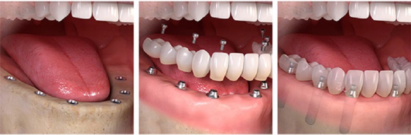 Phương pháp trồng răng Implant All on 6