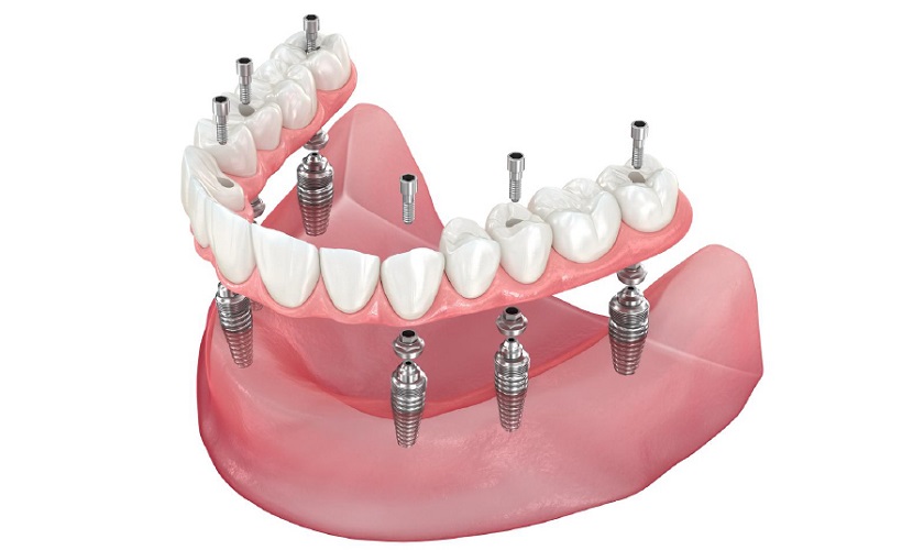 Trồng răng Implant All on 6 phù hợp với hầu hết các trường hợp mất răng toàn hàm