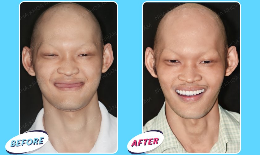 Khách hàng không răng bẩm sinh trước và sau điều trị tại Implant Center