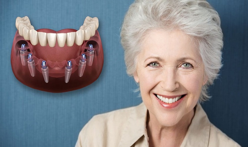 Trồng răng Implant cho người già là giải pháp tối ưu giúp cải thiện chất lượng cuộc sống