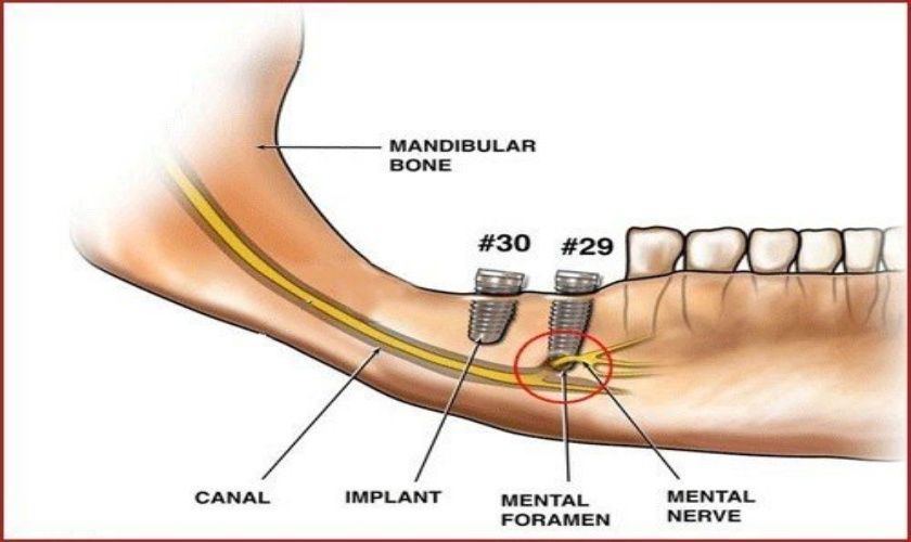 Trồng răng implant nếu kỹ thuật kém sẽ gây tổn thương các mô bên cạnh