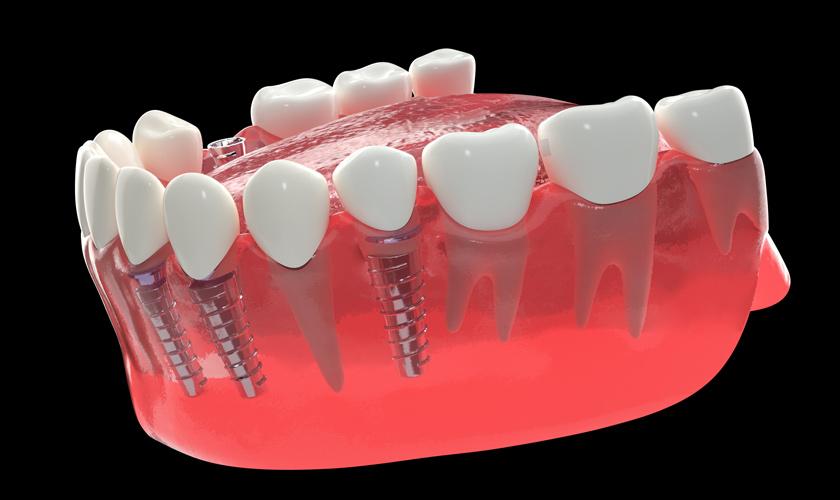 Trồng răng implant phương pháp khôi phục răng mất an toàn, hiệu quả