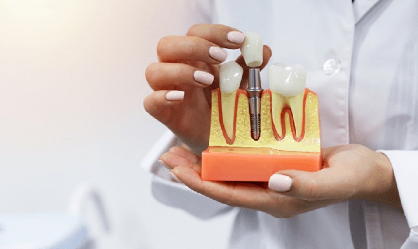 Trồng răng implant giá rẻ tại tphcm