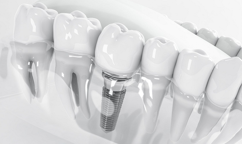 Trồng răng Implant là gì