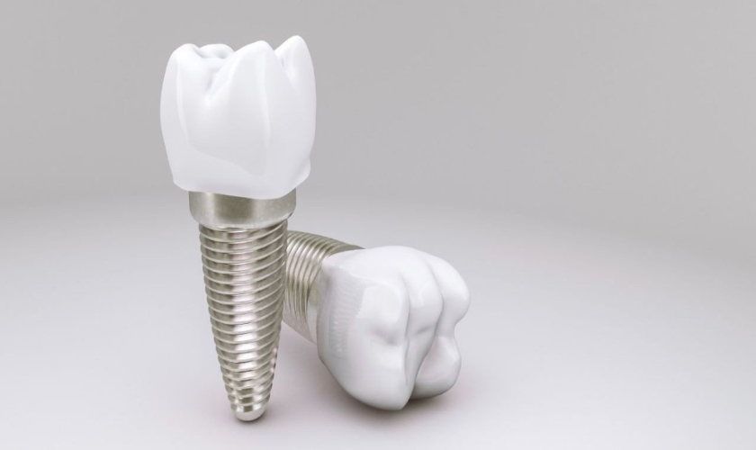 Trồng răng implant loại nào tốt hiện nay?