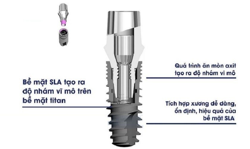 Trụ implant Pháp Tekka Kontact được ứng dụng công nghệ cao