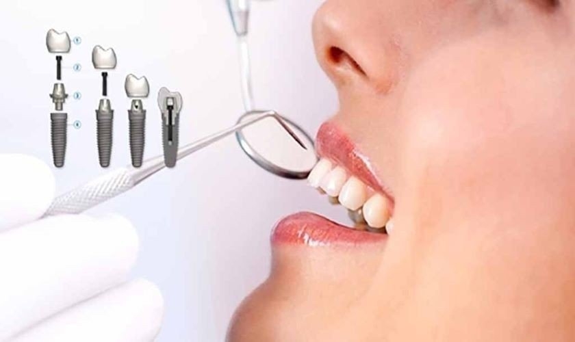 Trồng răng implant giải pháp khôi phục răng mất an toàn và hiệu quả