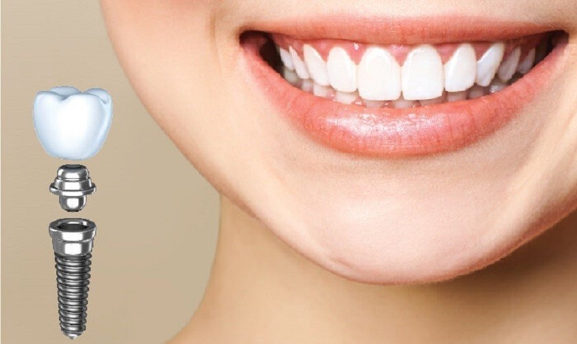 Nên trồng răng implant tại nha khoa uy tín