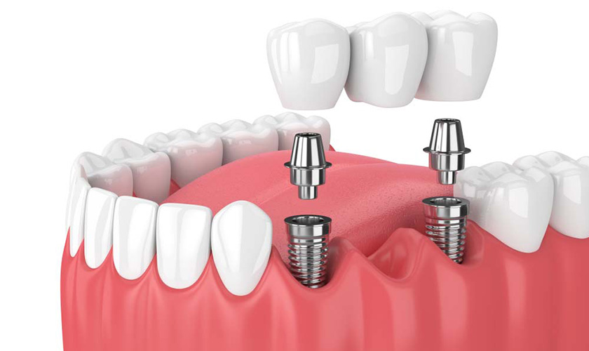 Trồng răng Implant thay thế một vài răng đã mất liền kề