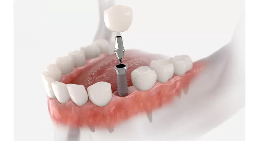 Trồng răng Implant không tác động đến các răng thật xung quanh