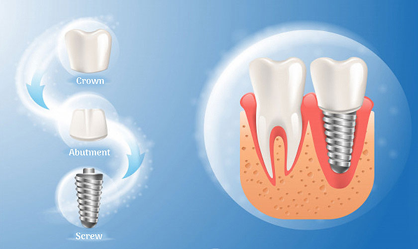 Trồng răng Implant thay thế răng đã mất
