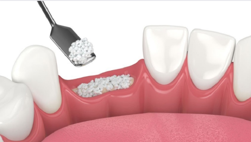 Thủ thuật ghép xương trong trường hợp mất răng lâu năm sẽ làm tăng chi phí điều trị