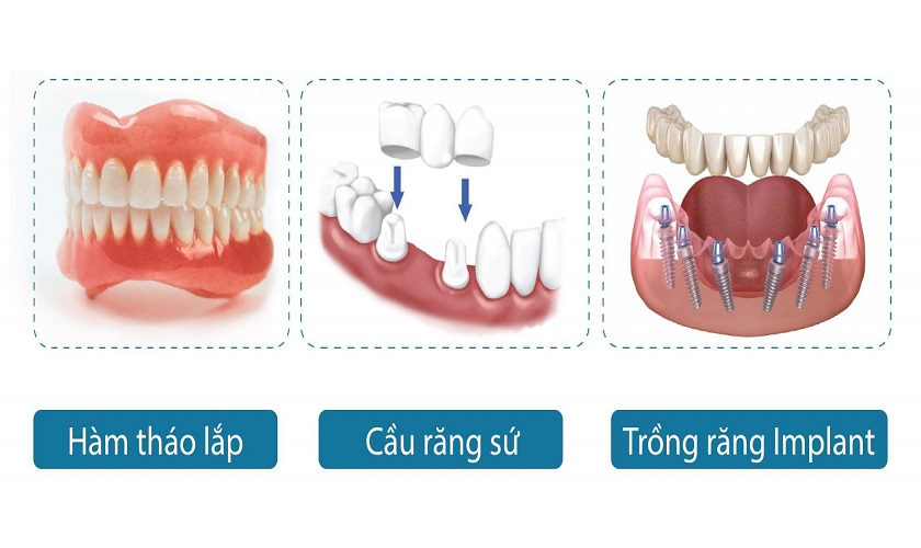 Thời điểm trồng răng sau nhổ phục thuộc vào phương pháp trồng răng áp dụng