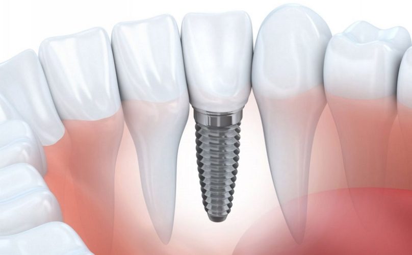 Trồng răng Implant là biện pháp phục hình tối ưu nhất hiện nay