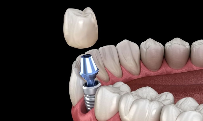 Trồng răng sứ vĩnh viễn nên chọn loại vật liệu nào? Chi phí ra sao?