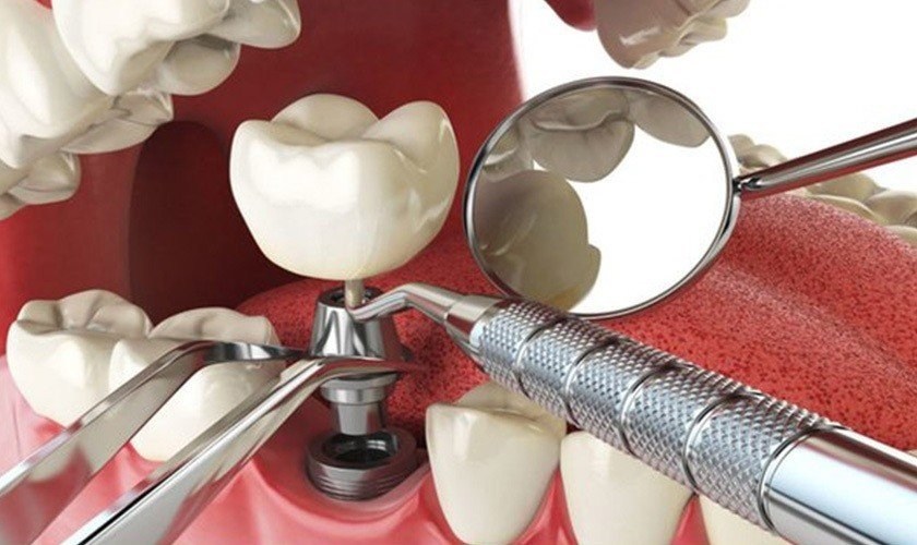 Trụ Implant Nobel TiUltra giải pháp khắc phục răng mất lâu năm