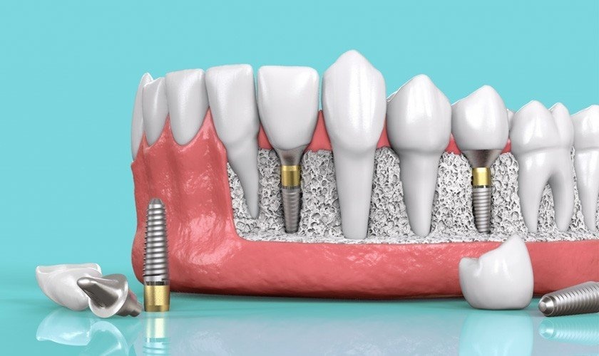 Trụ Implant Nobel TiUltra được bảo hành trọn đời