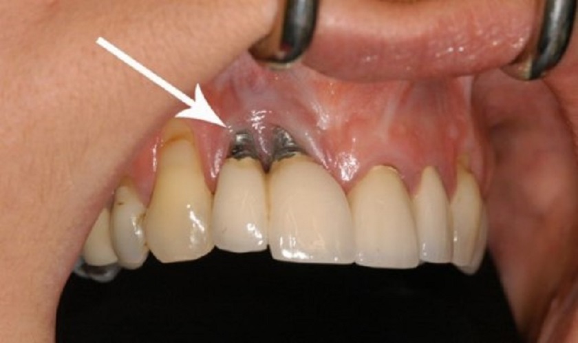 Cần thay trụ Implant mới khi Implant bị đào thải