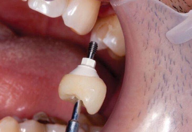 Thay thế vít mới, răng sứ mới khi vít kết nối cũ bị gãy