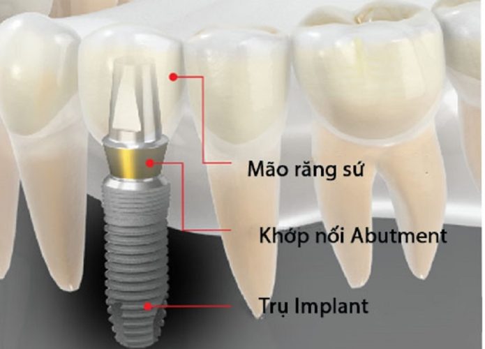 Thời gian cấy ghép được rút ngắn với trụ Implant Dentium Mỹ