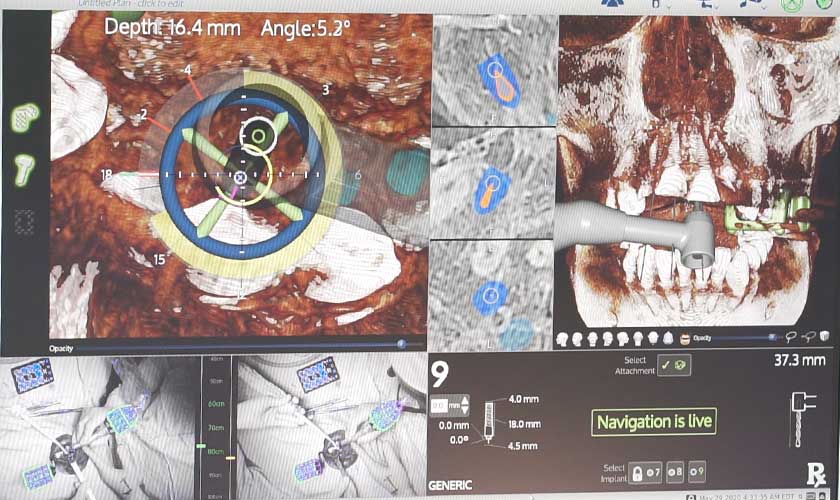 Công nghệ định vị X-Guide Navigation giúp bác sĩ xác định chính xác vị trí cấy ghép trụ Implant