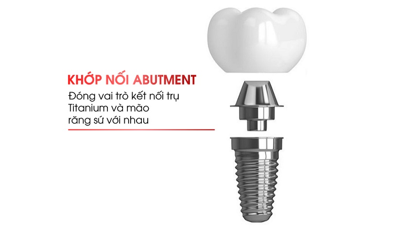 Abutment Implant là bộ phận kết nối chân răng và thân răng giả