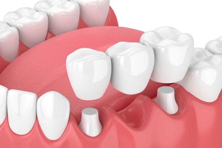 Bắc cầu răng sứ có bền không?