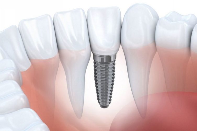 Phương pháp cấy ghép răng Implant