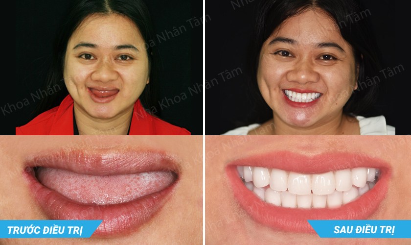 Không răng bẩm sinh – Nguyên nhân, ảnh hưởng và điều trị