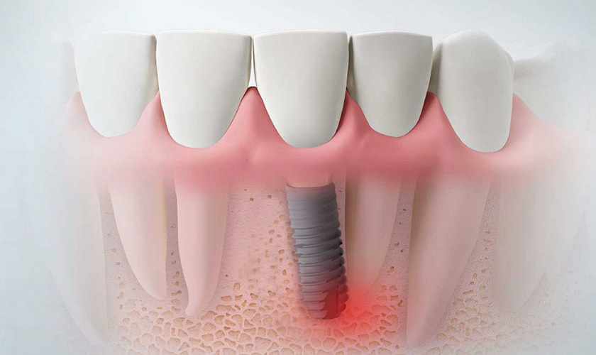 Khả năng tích hợp của trụ Implant với xương hàm kém