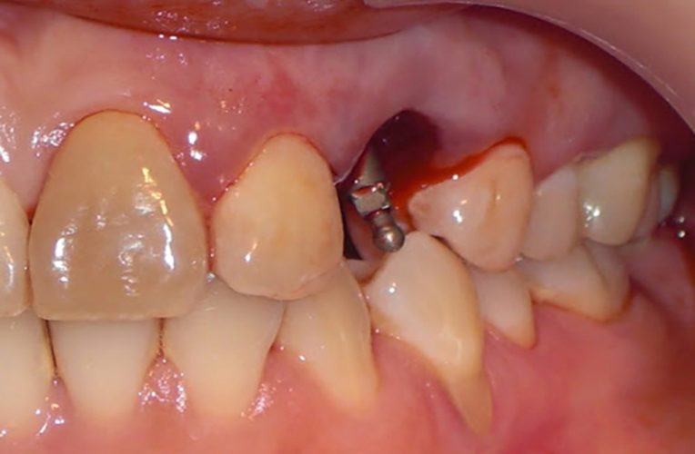 Xuất huyết sau khi cấy ghép Implant