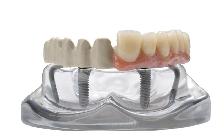 BioHPP có màu sắc và thẩm mỹ tự nhiên như răng thật