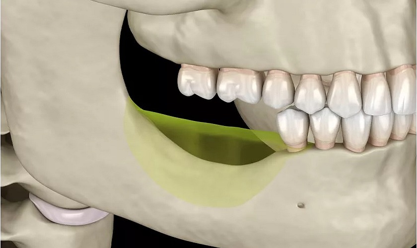 5 dấu hiệu tiêu xương răng bạn cần biết